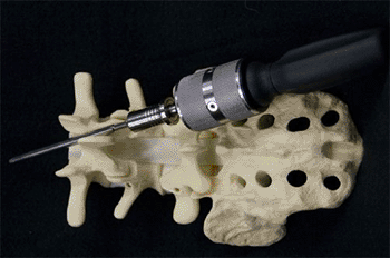 Image: The Kobalt Double Drive Medical Screwdriver (Photo courtesy of Double Drive Medical).